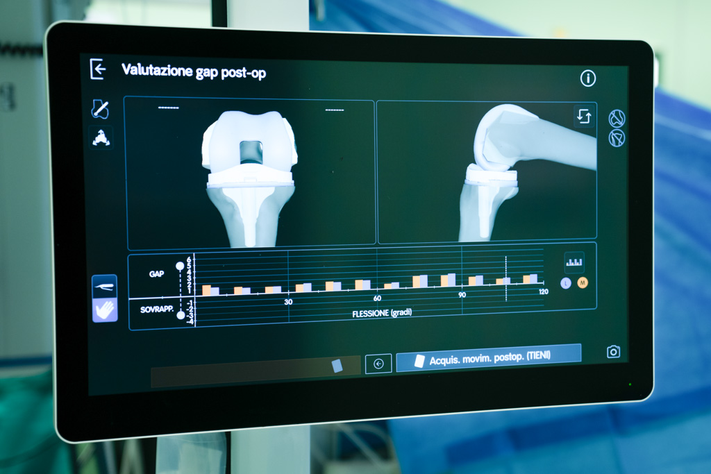 Valutazione del bilanciamento legamentoso sullo schermo del robot CORI