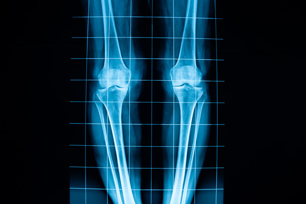 Radiografia degli arti inferiori per la valutazione dell’allineamento